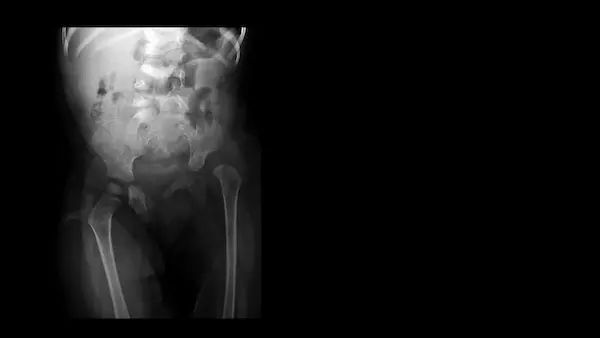 Developmental Dysplasia Hip Ddh Congenital